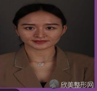 徐学东医生在哪个医院？北京画美医院做的双眼皮术前术后效果分享图