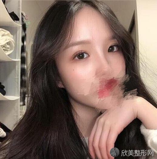 杭州瑞丽整形美容医院做双眼皮