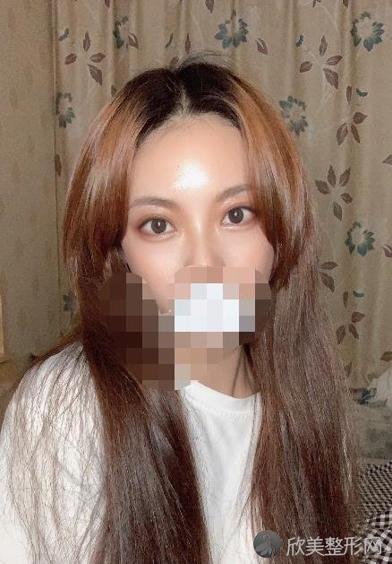 大理韩美整形美容医院做双眼皮之后