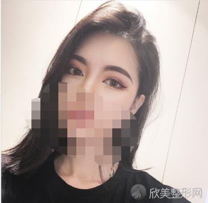 南京艺莱医疗美容做双眼皮之后