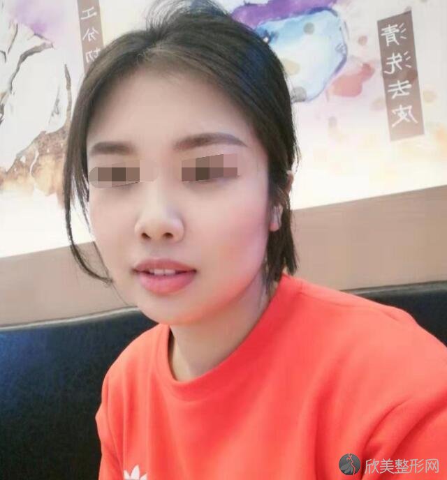 光子嫩肤术后20天