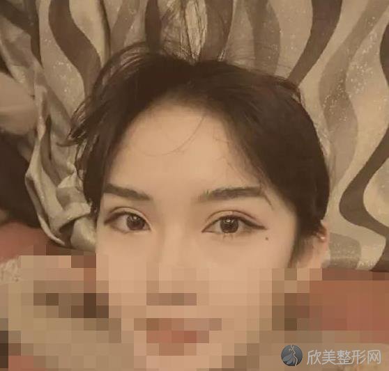 合肥春语医疗美容医院做双眼皮之后