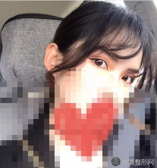 合肥春语医疗美容医院做双眼皮之后