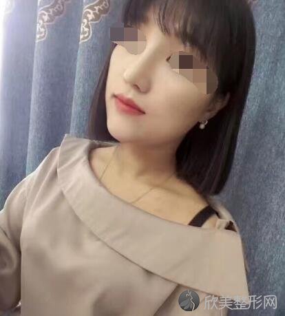 隆鼻术后30天