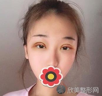 苏家屯中兴美容院双眼皮做的怎么样？看我的亲身经验和案例反馈就知道啦-价