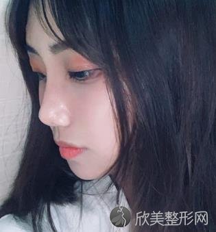 南昌二附院整形美容科双眼皮整形案例分享，内附价格表