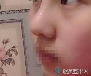 佛山顺德壹加壹整形医院隆鼻案手术怎么样？分享术后及对比内含2021较新价格