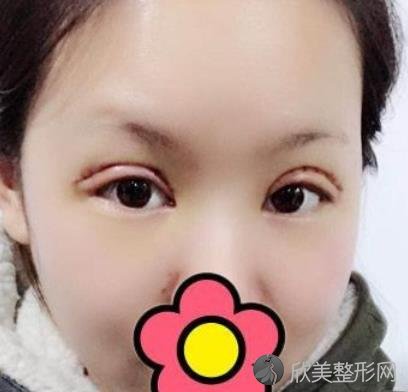 上海九院刘凯双眼皮效果到底如何？内附真实案例不要错过~