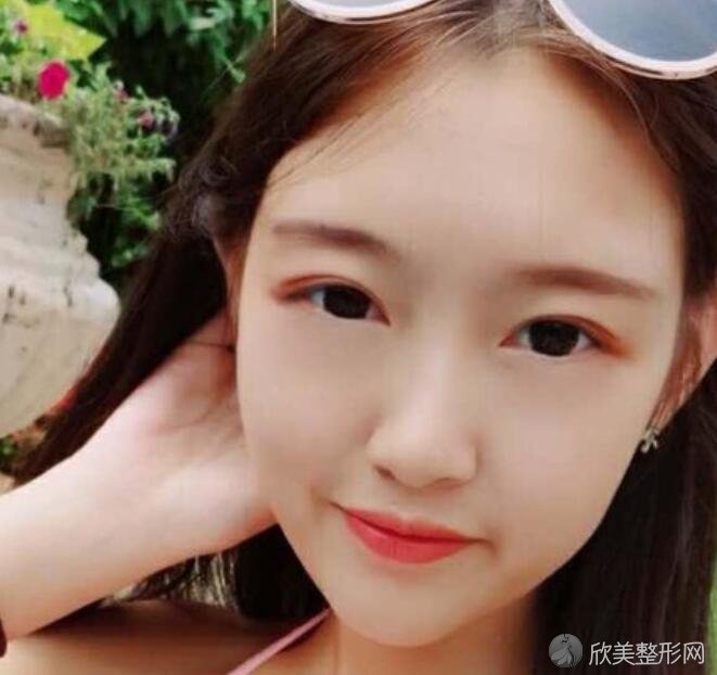 伽美整形面部吸脂案例，精致小脸你不爱吗？