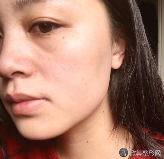 妹纸做果酸换肤前后对比美白嫩肤界的hermes