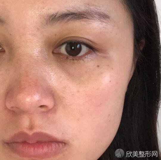 妹纸做果酸换肤前后对比美白嫩肤界的hermes