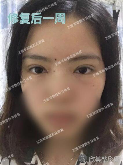 北京双眼皮修复案例 你喜欢后天的天然呆女孩么