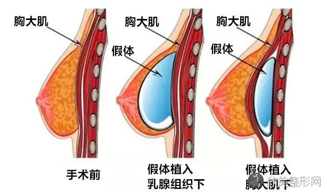 成都隆胸医生罗丽达技术如何？附个人简介及隆胸前后注意事项