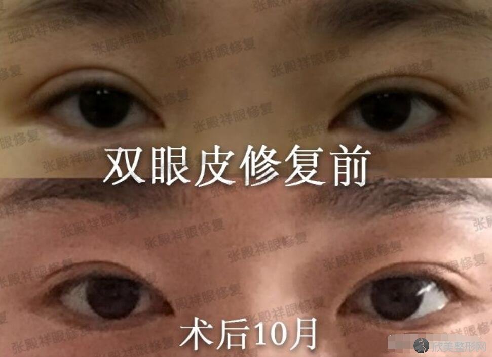 北京有哪些擅长做双眼皮的医生？附上简介及案例图片