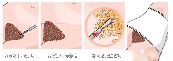 北京协和整形外科赵茹医生科普吸脂手术