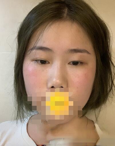 华西医院段伟强做双眼皮如何？附双眼皮案例分享