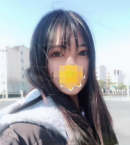 台湾嘉仕美整形医院李进良医生做眼睛如何？附双眼皮真实例子