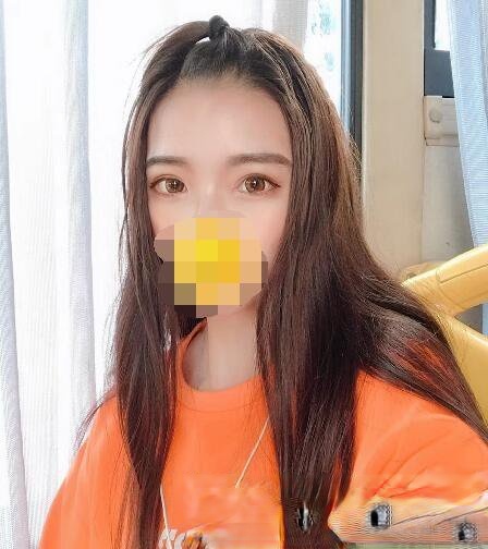 台湾嘉仕美整形医院李进良医生做眼睛如何？附双眼皮真实例子