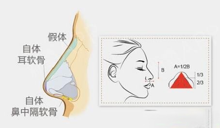 香港V Beauty医学中心陈医生科普隆鼻手术