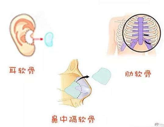 香港V Beauty医学中心陈医生科普隆鼻手术