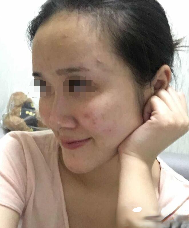 铜雀台周柯做鼻子怎么样？小姐姐做完隆鼻后鼻子拔地而起！