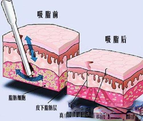 华西医院肖海涛做吸脂