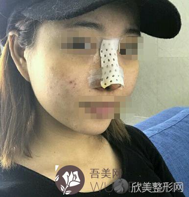 刘彦军医生技术好不好?附上医生简介+眼鼻综合真实案例图