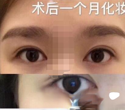 丁力医生做开眼角整形技术怎么样？内附个人真实案例