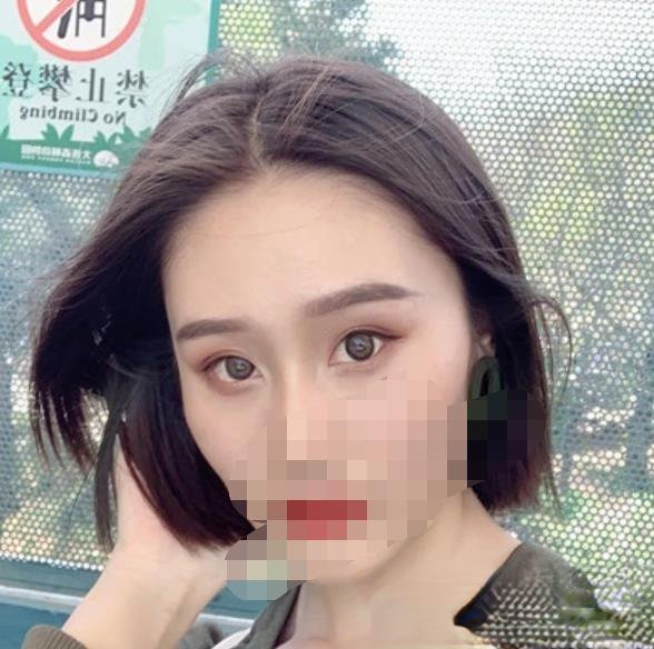 李永胜医生做双眼皮技术如何？附实操双眼皮手术真实案例