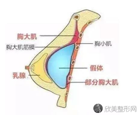 脂肪隆胸