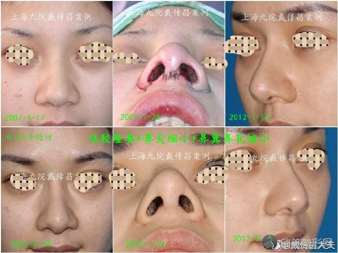 上海鼻修复专家戴传昌鼻修复案例