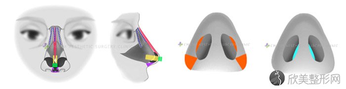 隆鼻失败之多次鼻整形手术后的朝天猪鼻子怎么修复？