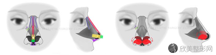 隆鼻失败之鼻整形手术后挛缩、鼻头朝天变形怎么修复？