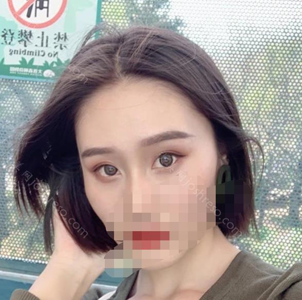 上海美莱整形美容医院杜医生双眼皮之后