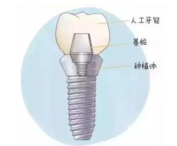 深圳即刻种植牙是什么？这种种植牙有什么优势呢？