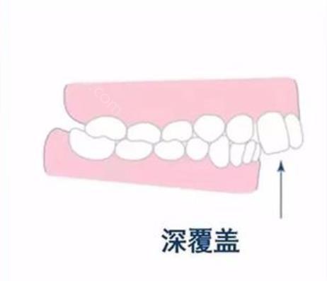 深覆盖1