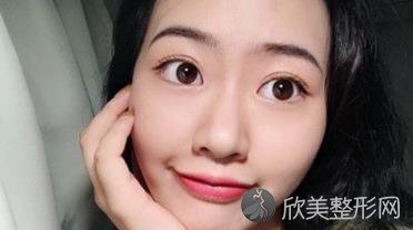 兰州美月整形医院怎么样？双眼皮案例+价格表