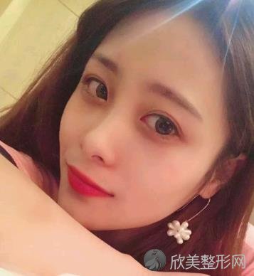 杭州绽美整形医院怎么样？内附双眼皮案例分享以及价格表