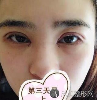 西安高一生史文君医生技术到底怎么样？双眼皮案例图欣赏+较新价格表分享