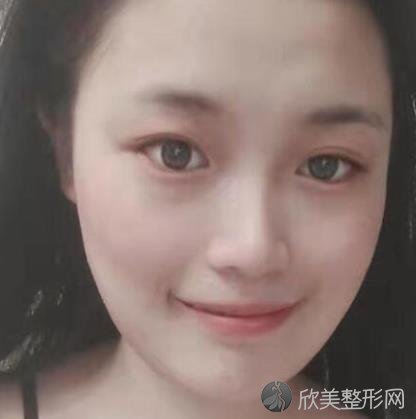 北京八大处靳小雷下颌角磨骨怎么样？附真人术后恢复效果图+价格表一览