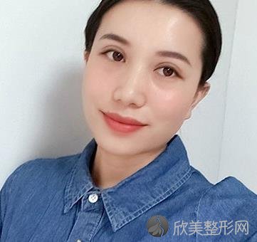 嘉兴禾美赵学燕做眼睛怎么样？双眼皮恢复1个月效果图+价格表