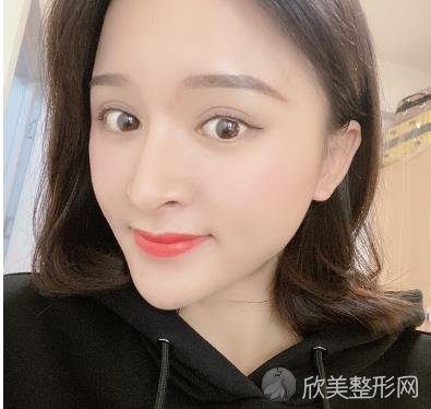 徐学东医生在哪家医院？北京画美徐学东个人介绍+双眼皮手术效果分享