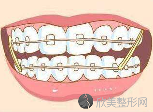 杭州至恒口腔门诊部牙齿隐形矫正价钱多少 矫正牙齿贵吗