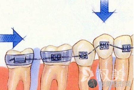 牙齿拥挤怎么矫正 杭州口腔医院哪家好