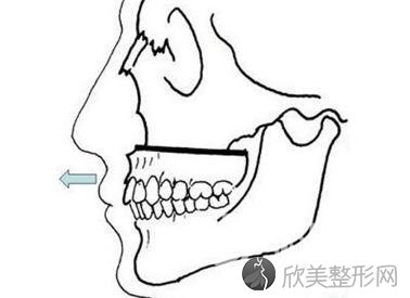 浙江中医院整形科地包天矫正的方法有哪些  有没有危害