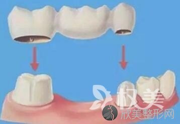 烤瓷牙的类型有哪些  具体优势有哪些