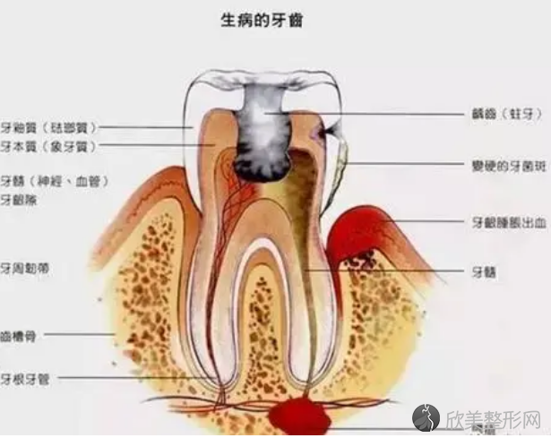 牙神经是什么？根管治疗拔出来的牙神经图片