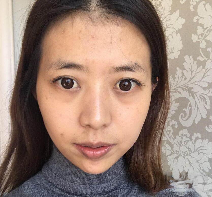 云南华美美莱李韬自体脂肪填充全脸效果对比