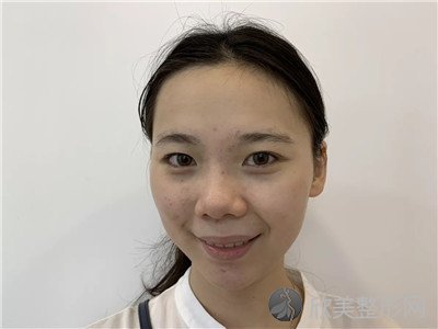 北京新星靓李伟民做面部提升怎么样？附案例-全新价格表