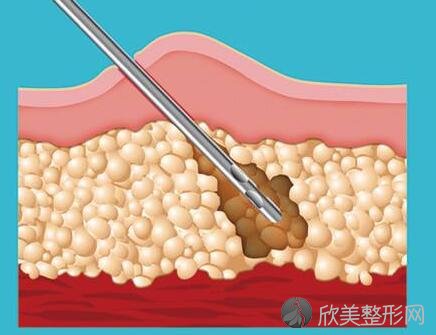 光纤溶脂